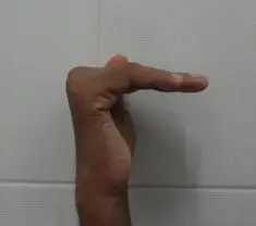 Late postoperative picture shows improvement of the claw defromity