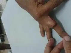 Recurrent giant cell tumor of hand