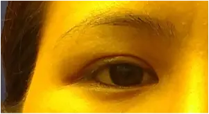 Postoperative image of unilateral Asian blepharoplasty