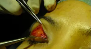 Intraoperative image of unilateral Asian blepharoplasty