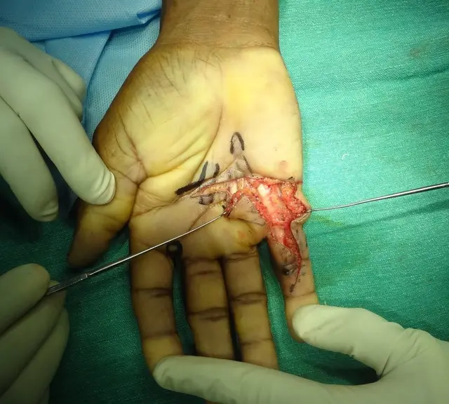 Surgical removal of the diseased cords