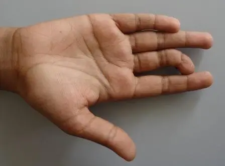 After crush injury with soft tissue and bony abnormalities