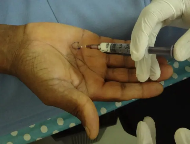 Local injection of steroid into the nodules