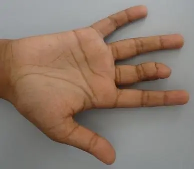 Straightening of the digit which allows improved fist making following release of the contracture.