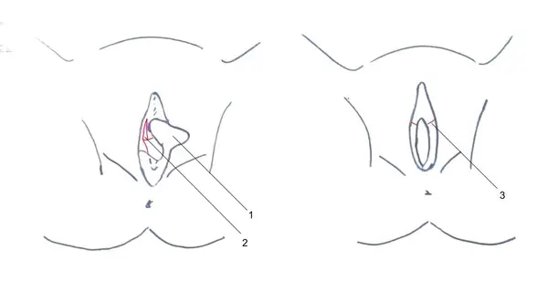 Labia minora reduction