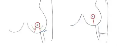 Breast reduction with key-hole incision