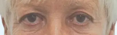 Youthful appearance after upper lid blepharoplasty