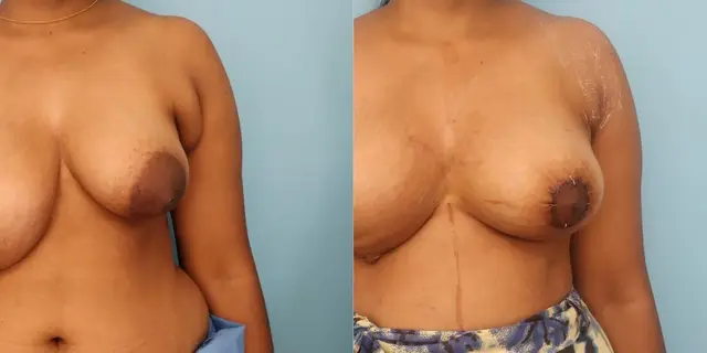 Left sided axillary breast removal in addition to areolar reduction and fat grafting