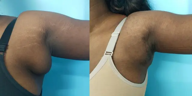 Axillary breast | Early postoperative appearance