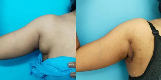 Axillary breast | Early postoperative appearance. Scars usually fade out in a few months