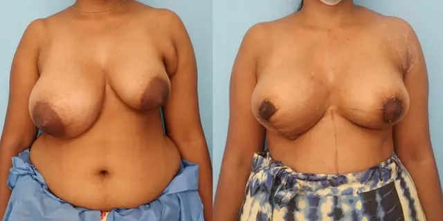 Before and after images with superomedial pedicle based breast reduction on the right and fat grafting, areolar reduction, and axillary breast excsion on the left.
