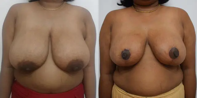 Before and after breast reduction with a medial pedicle.