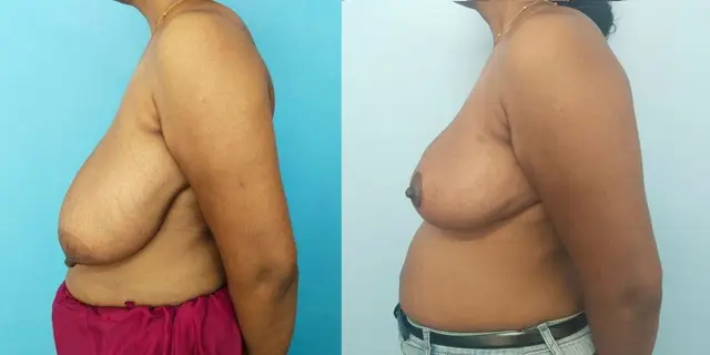 Lateral view of the above patient. Improvement in projection and nipple position is seen.