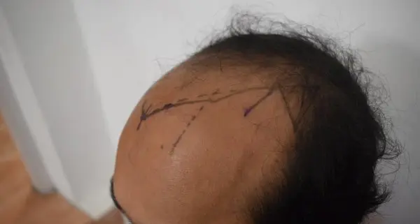 Hairline design marked with pen