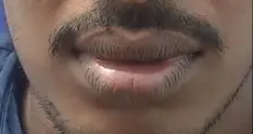 Before upper and lower lip reduction