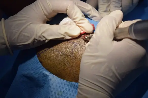 Use of motorized punch for scoring follicular units
