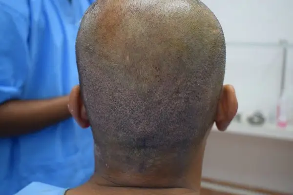 Almost healed donor area at the end of procedure