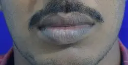After upper and lower lip reduction