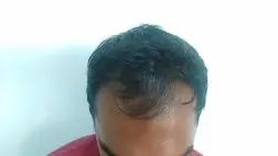 Male pattern baldness