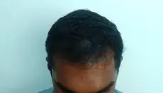 FUE | 1920 FUG | 5 months post-op