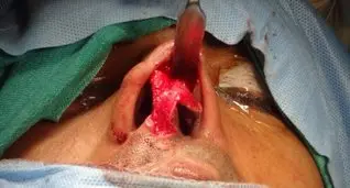 Open rhinoplasty image for correction of the cleft lip nose deformity. The abnormal relation of the lower lateral cartilages are seen.