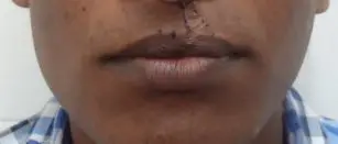 Stretched lip scar in a cleft lip patient