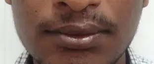 After lip scar revision as well as redo of the lip