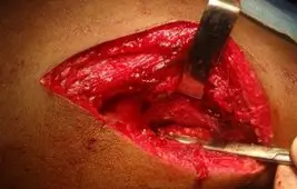 Spinal accessory to SSN (nerve transfer) for shoulder stabilization in C5-C6 injury