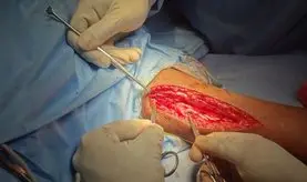Oberlin plus nerve transfer for elbow flexion in C5-C6 injury