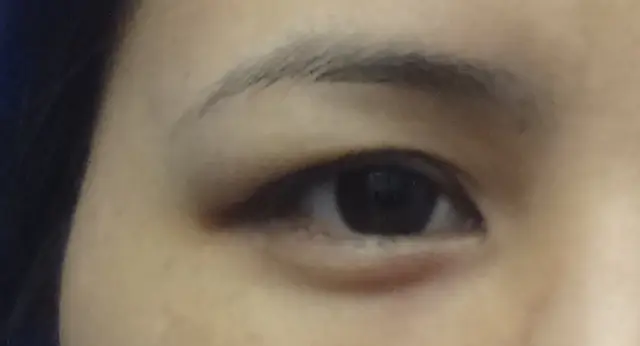 Preoperative image of unilateral Asian blepharoplasty