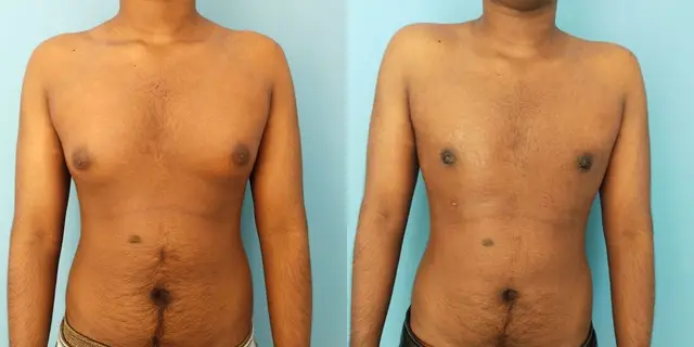 Gynecomastia | Frontal view | After liposuction and gland excision