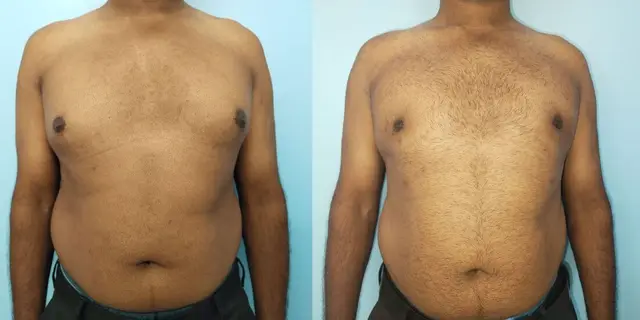 Gynecomastia | Frontal view | After liposuction and gland excision