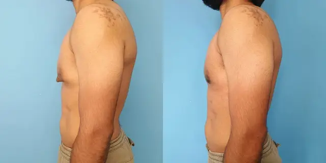 Gynecomastia | Lateral view | After liposuction and gland excision
