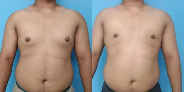 Gynecomastia | Frontal view | After liposuction and gland excision | Some residual swelling is seen in lateral chest wall