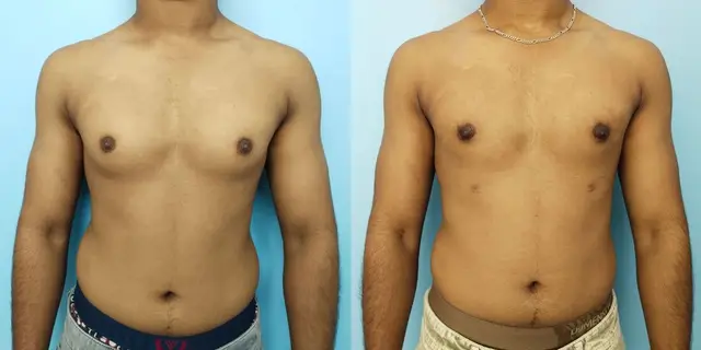 Gynecomastia | Frontal view | After liposuction and gland excision