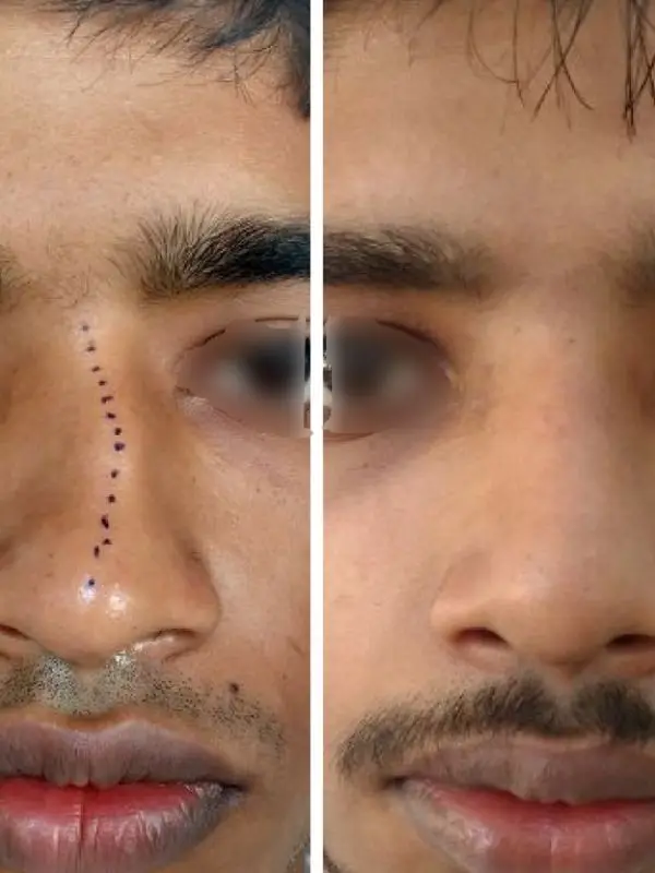 Rhinoplasty | Before and After