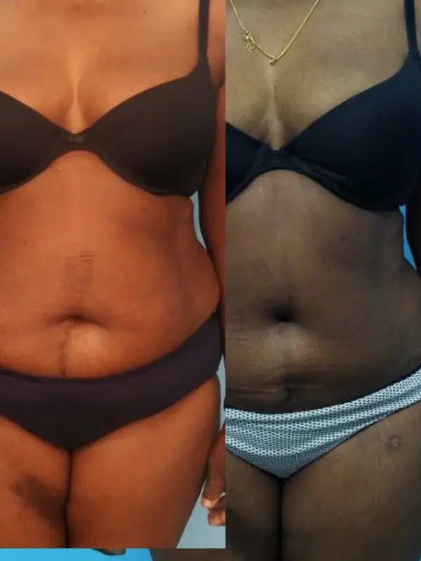 Abdominoplasty | Before and After