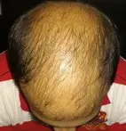 Male Pattern Baldness
