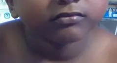 Congenital torticollis showing deviation of the chin to the opposite side