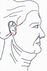 Incision (shown in red) lies inside the hairline and along the natural skin creases. Facelift rejuvenates the middle and lower third of face.