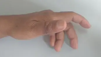 After removal of the vascular tumor