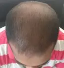 After conservative management with medicines and topical minoxidil.