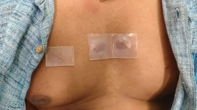 Topical silicone sheet application