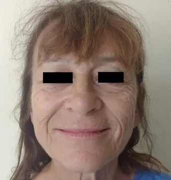 Before facelift (frontal view)