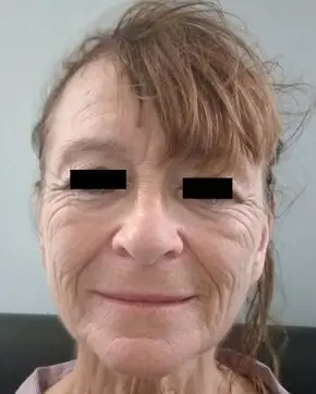 After low SMAS facelift (frontal view)