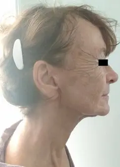 After low SMAS facelift and neck lift with corset platsymaplasty