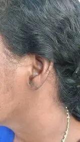 Keloid treated with surgery and external radiotherapy