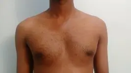 Post-op view of the same patient treated with liposuction and gland excision.