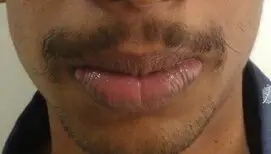 Early postoperative image after upper and lower lip reduction