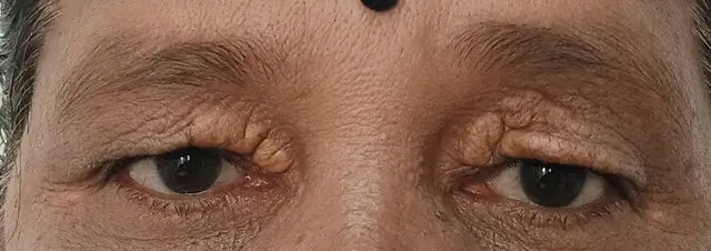 Extensive xanthelasma of both upper eyelids